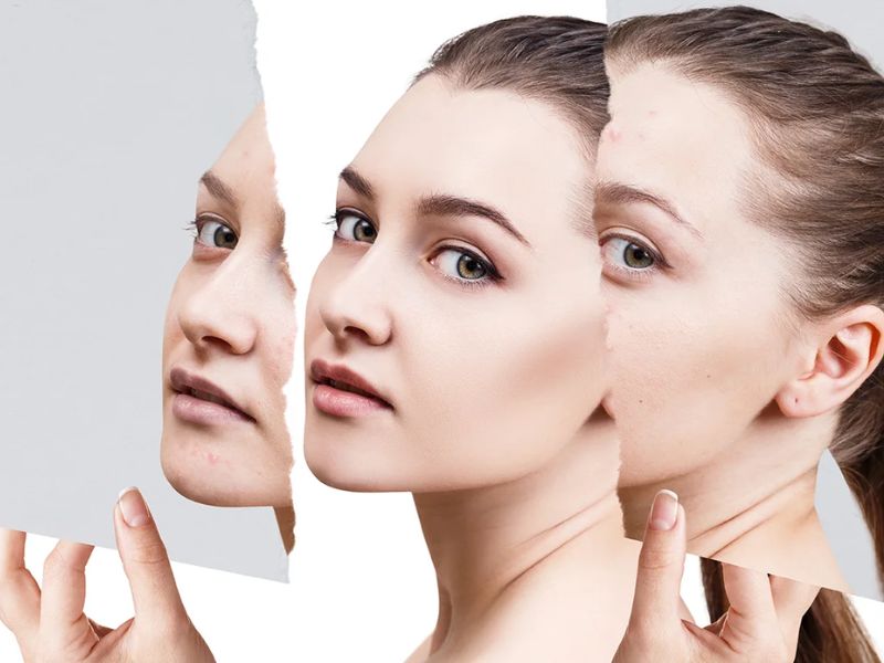 Điều trị sẹo bằng công nghệ IPL - 10