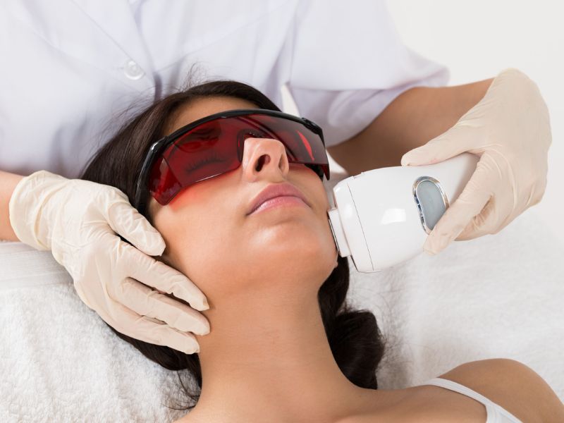 Điều trị sẹo bằng công nghệ IPL - 11