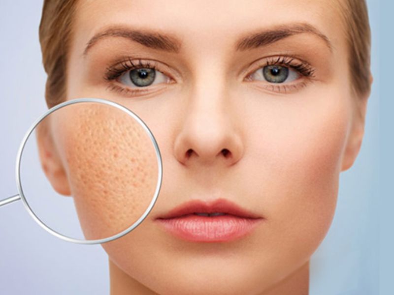 Điều trị sẹo bằng công nghệ IPL - 4
