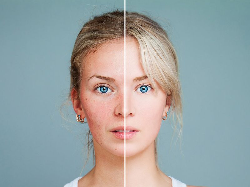 Điều trị sẹo bằng công nghệ IPL - 9