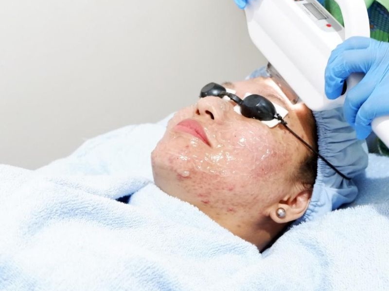 Điều trị trứng cá bằng ipl là gì - 1
