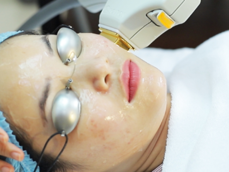 Điều trị trứng cá bằng ipl là gì - 2