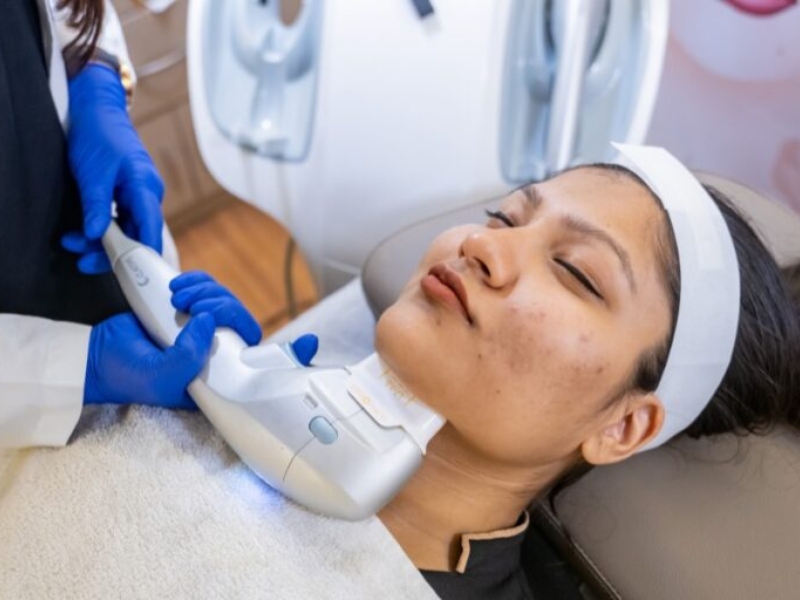 Điều trị trứng cá bằng ipl là gì - 3
