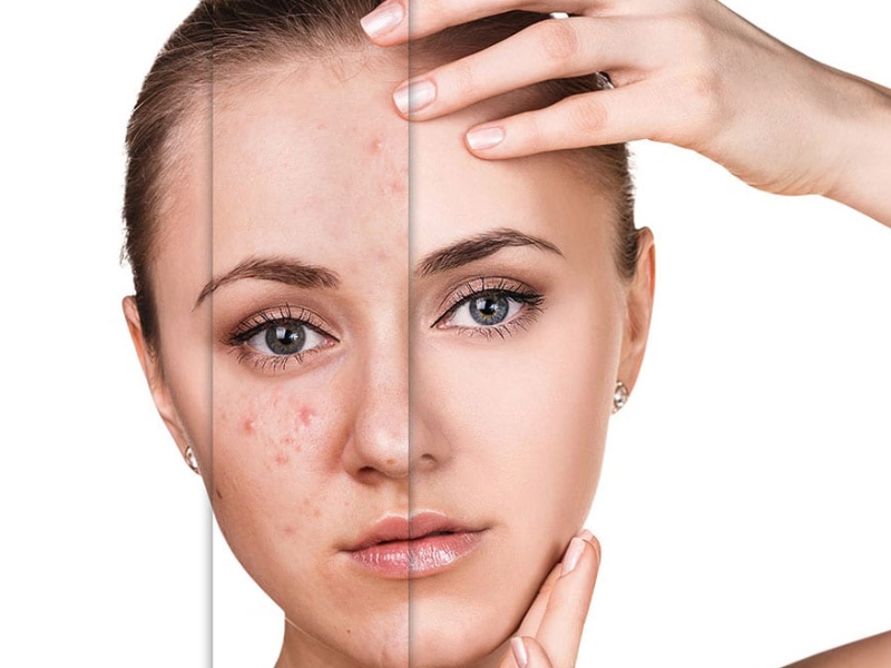Điều trị trứng cá bằng ipl là gì - 4