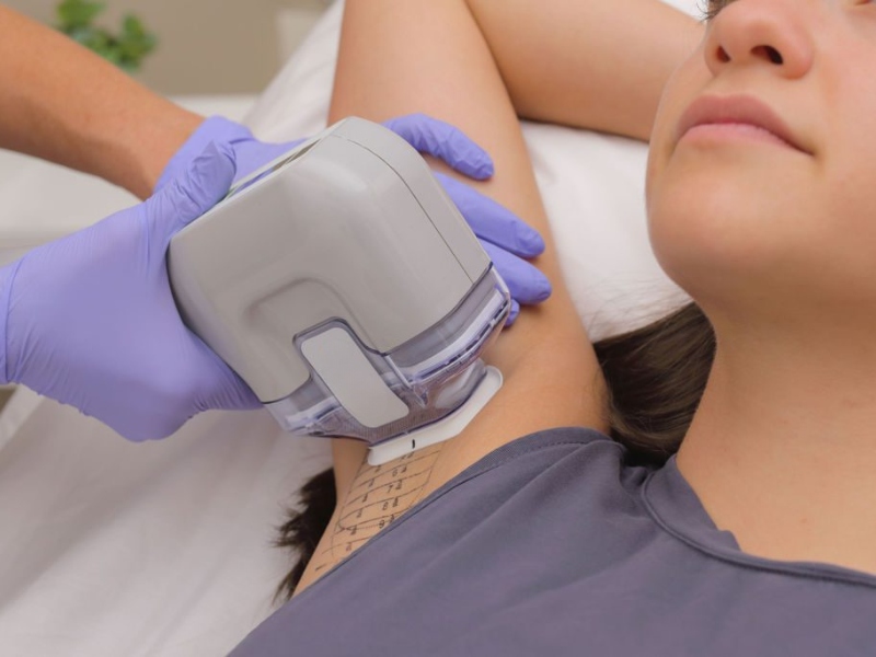 Đốt laser tuyến mồ hôi nách - 3