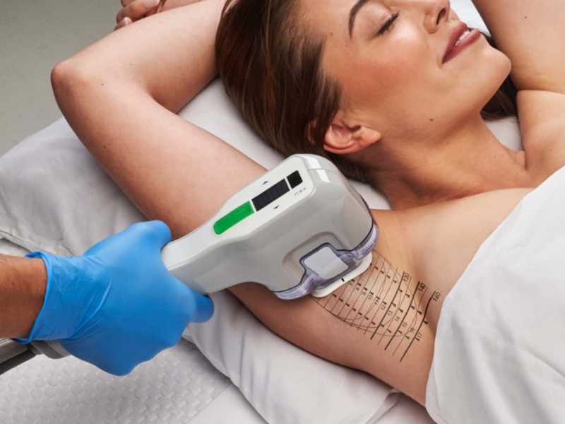 Đốt laser tuyến mồ hôi nách - 4