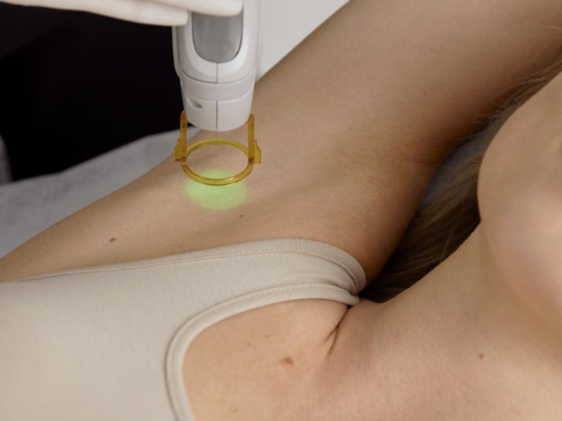 Đốt laser tuyến mồ hôi nách - 5