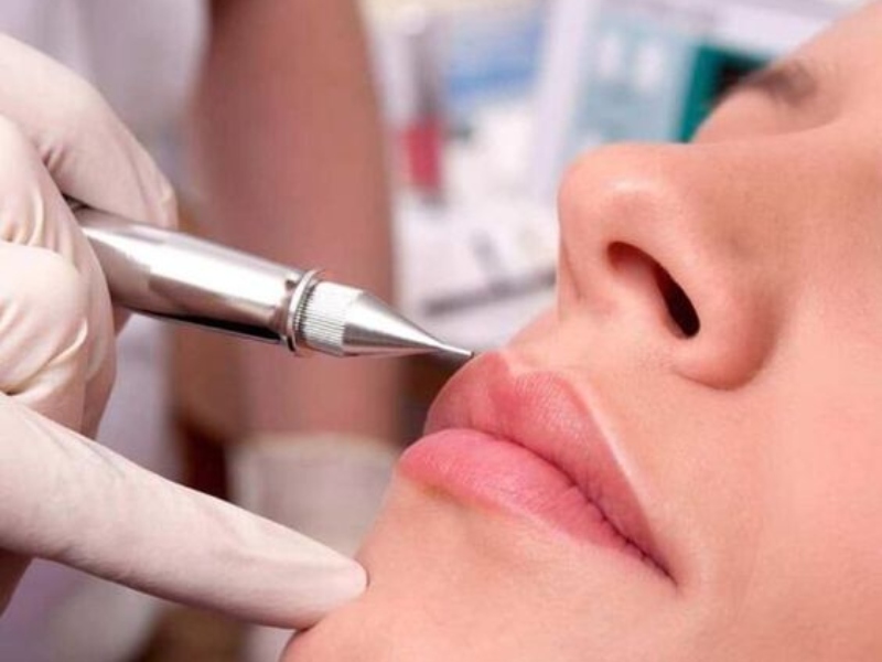 Khử thâm môi bằng laser - 2