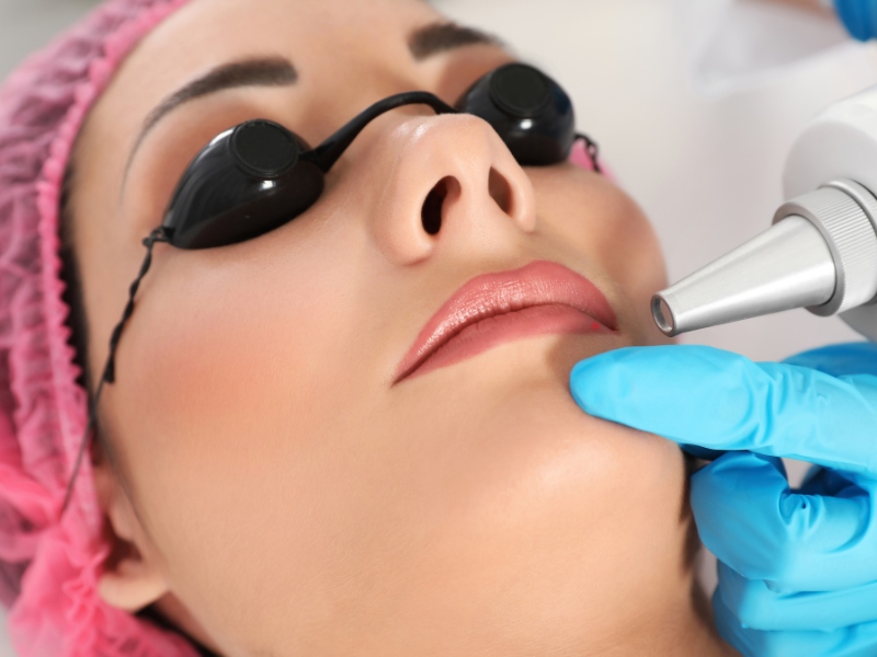 Khử thâm môi bằng laser - 3