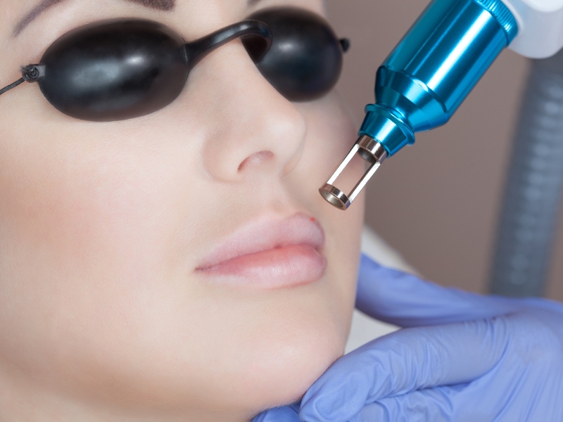 Khử thâm môi bằng laser - 5