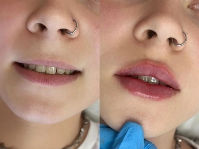 Khử thâm môi bằng laser - 6