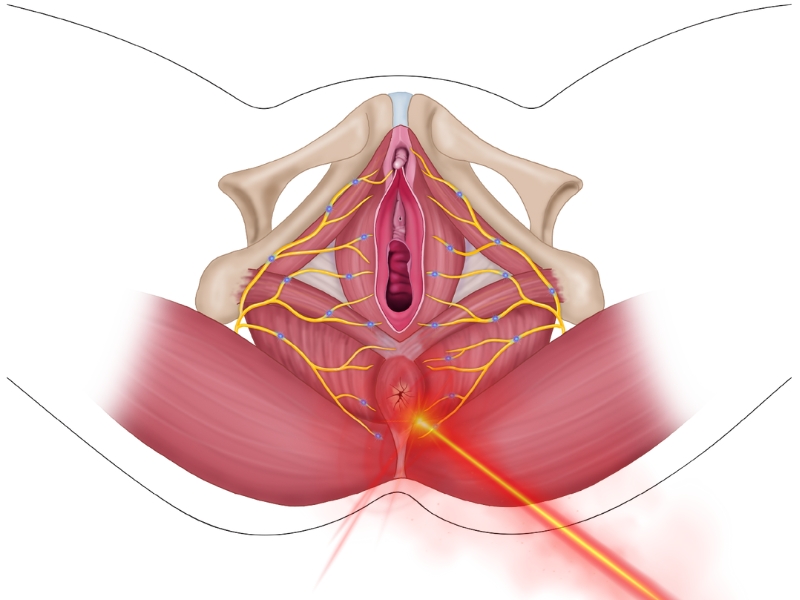 làm hồng vùng kín bằng laser bao nhiêu tiền - 1