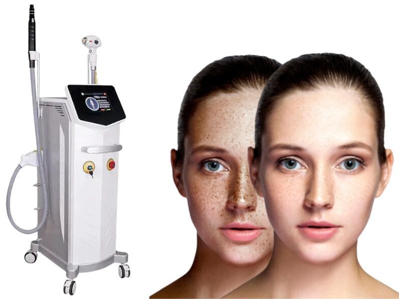 laser toning và laser picosure - 2