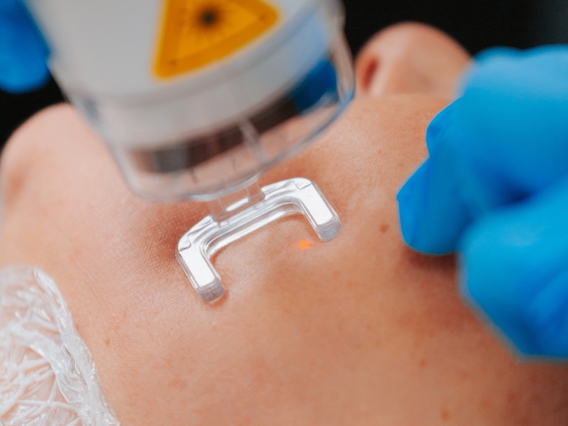 Laser trị thâm - 3