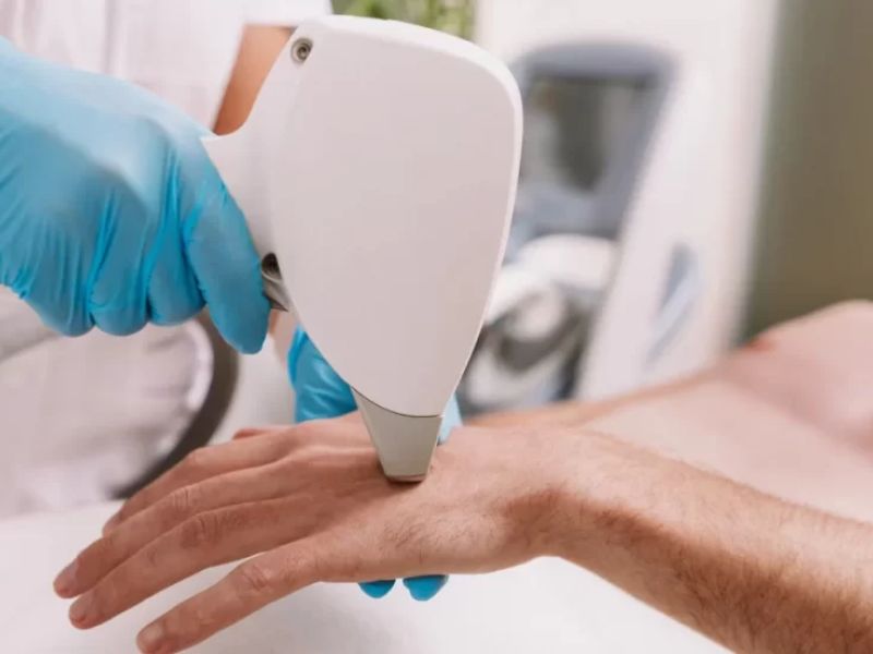 Máy triệt lông công nghệ IPL - 2