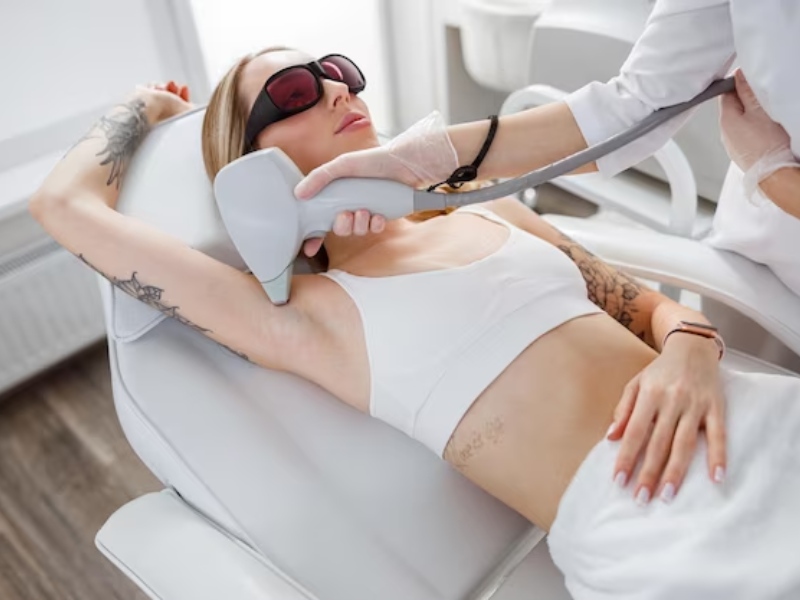 Máy triệt lông laser - 4