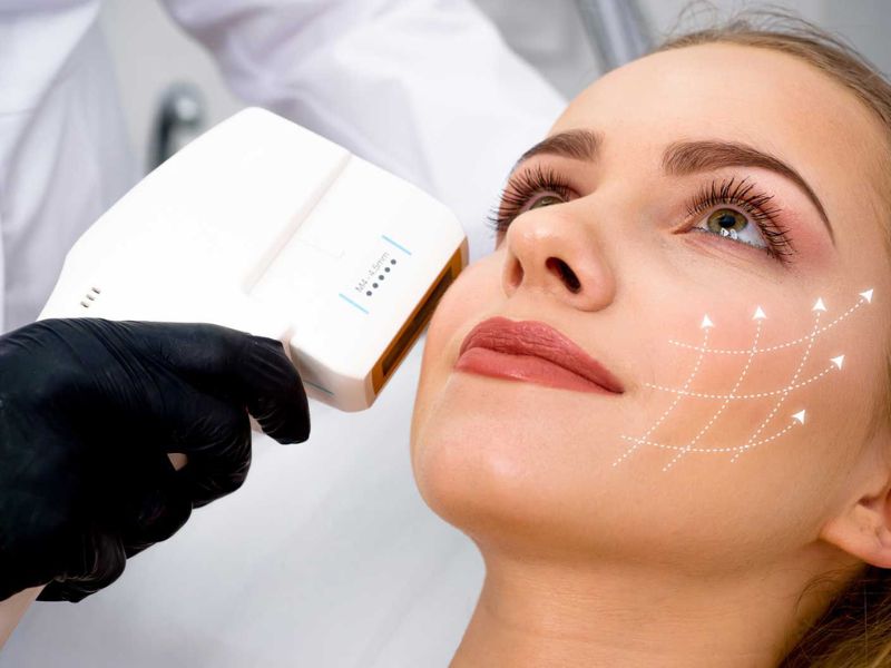 Nâng cơ Hifu có hiệu quả không - 4