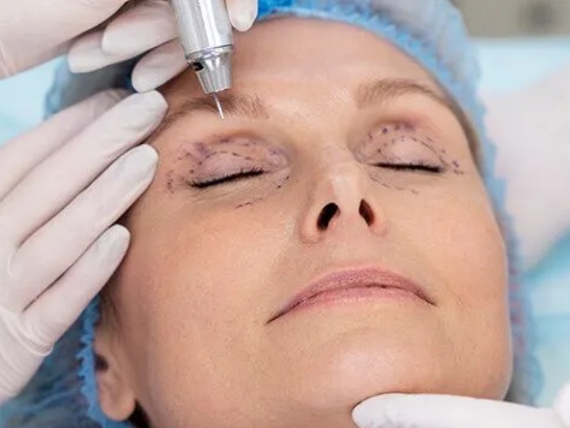 nhấn mí plasma có tốt không - 1