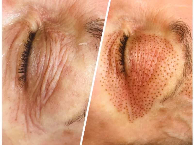 nhấn mí plasma có tốt không - 2