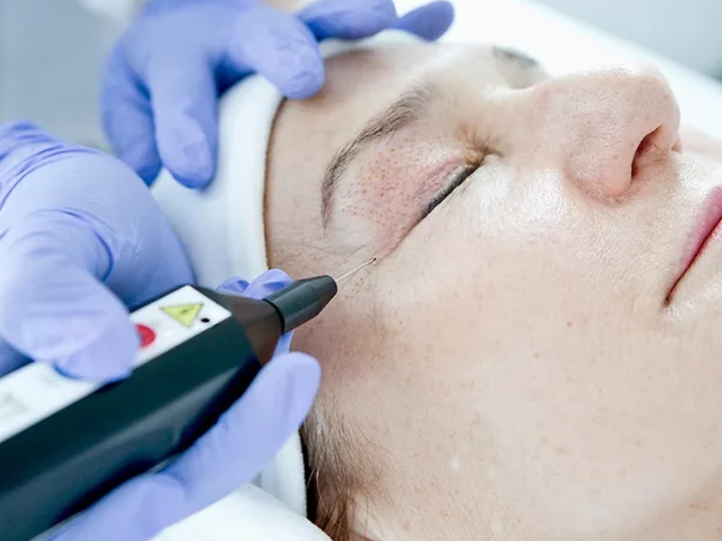 nhấn mí plasma có tốt không - 3