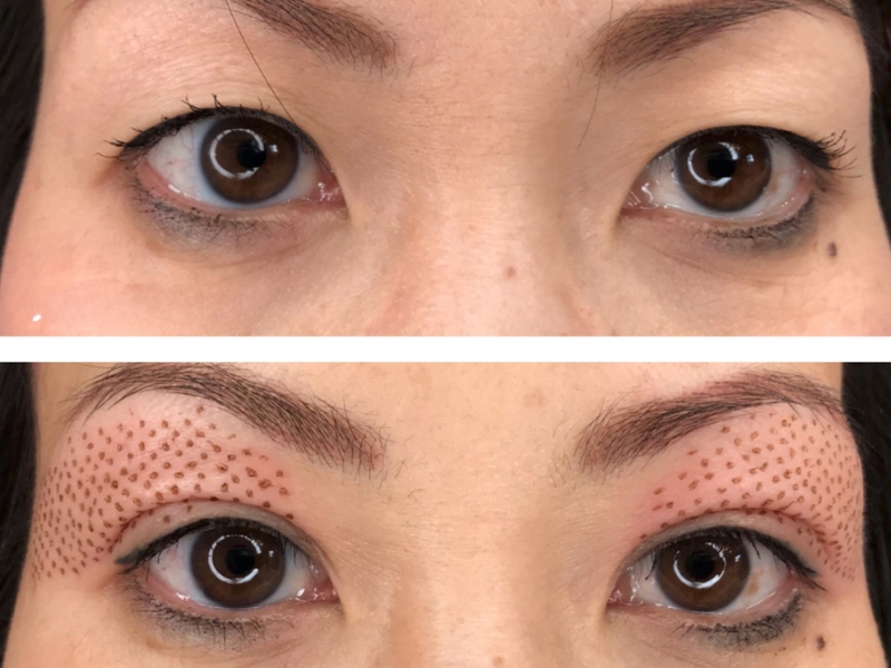 nhấn mí plasma giá bao nhiêu - 3