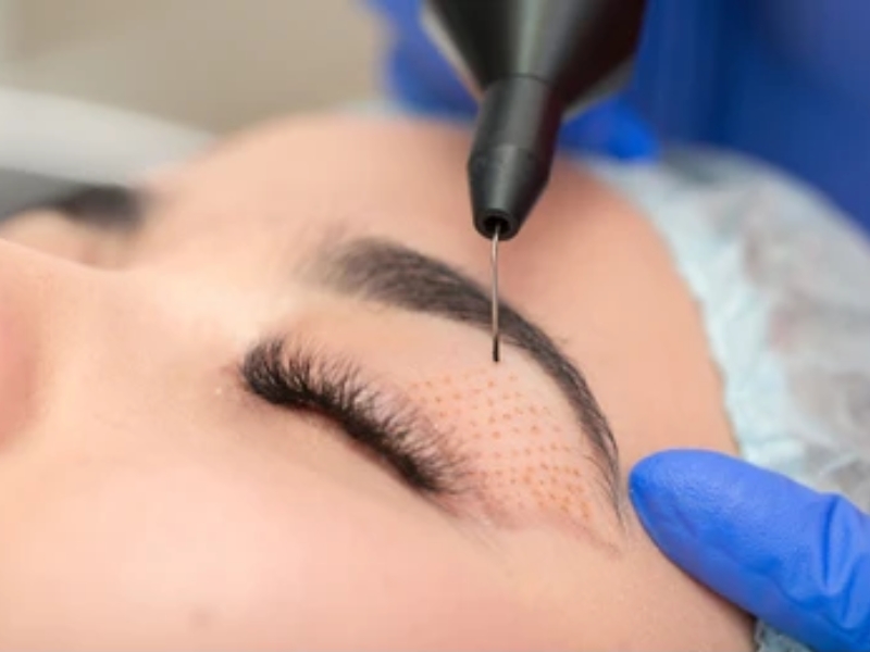 nhấn mí plasma giữ được bao lâu - 2