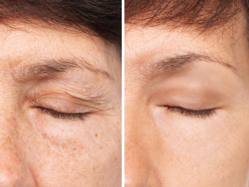 review cắt mí plasma - 3