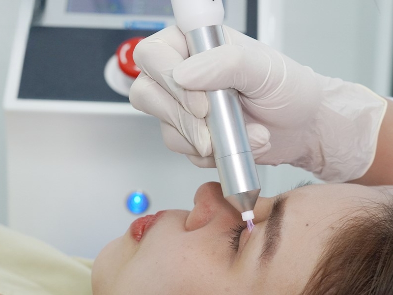 review cắt mí plasma - 4
