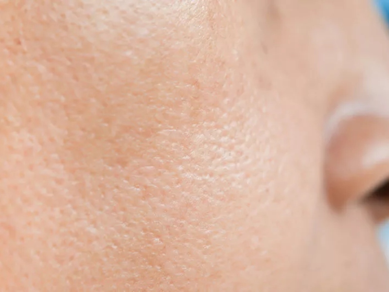 Se khít lỗ chân lông bằng tia laser - 1