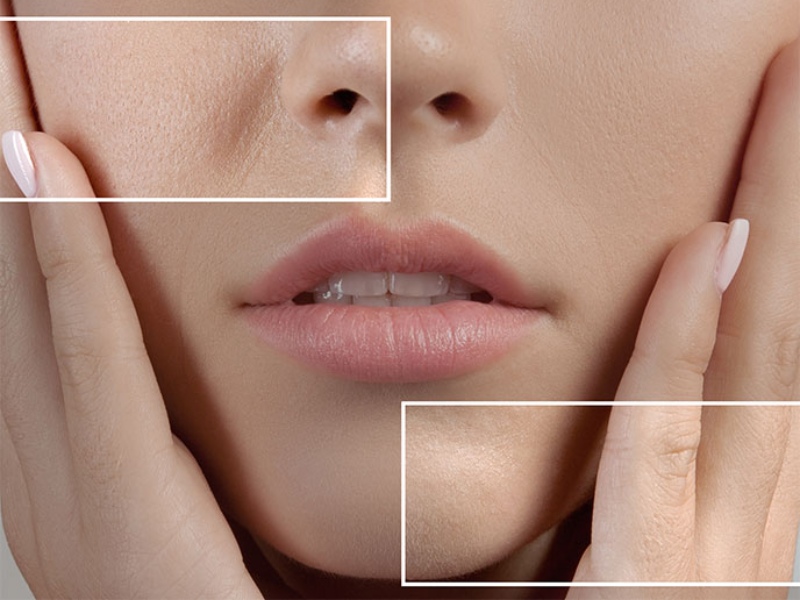 Se khít lỗ chân lông bằng tia laser - 11
