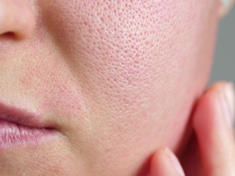 Se khít lỗ chân lông bằng tia laser - 2