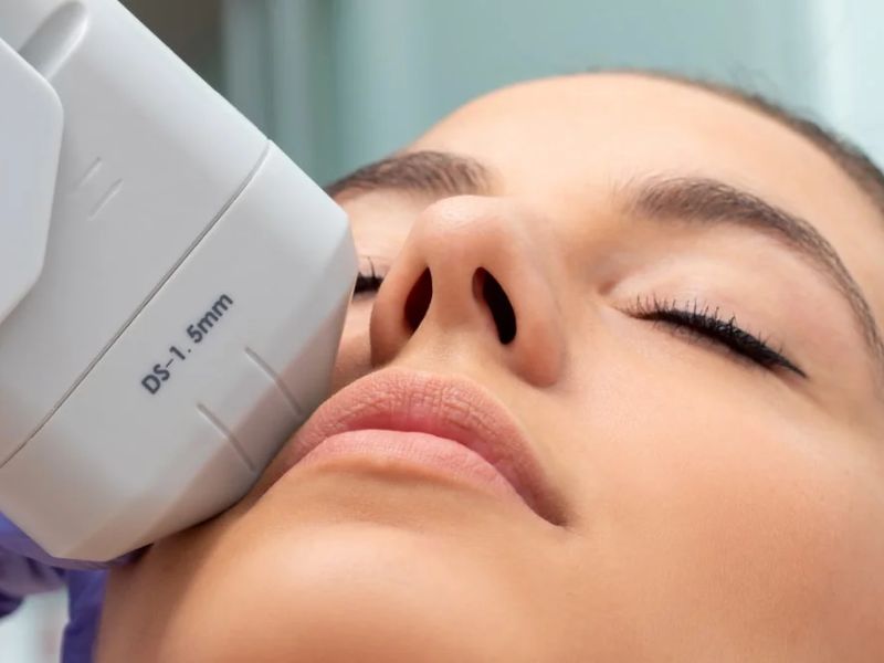 So sánh công nghệ Hifu và Thermage - 2