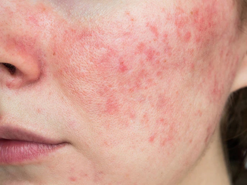 Tác hại của nâng cơ hifu - 2