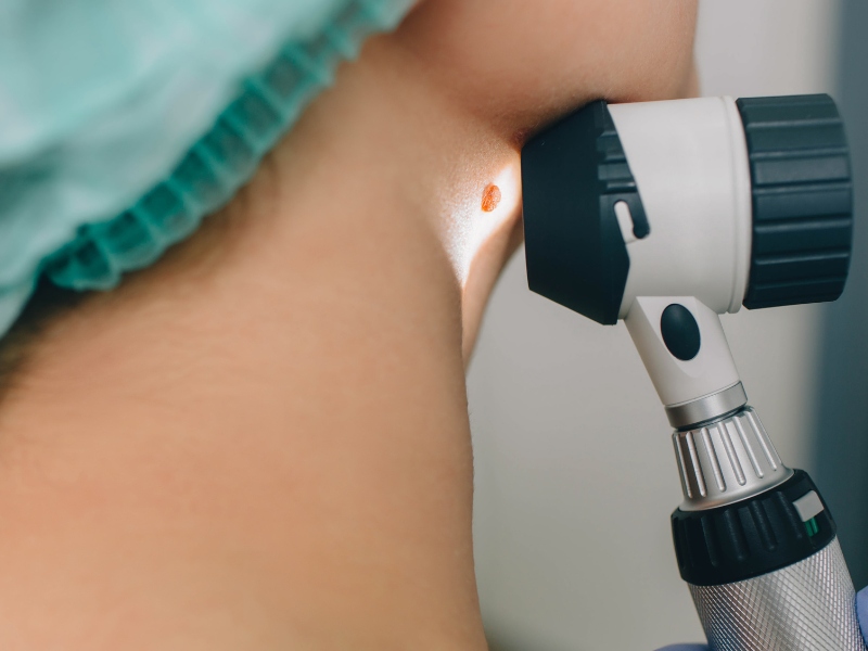 Tẩy nốt ruồi bằng laser - 2