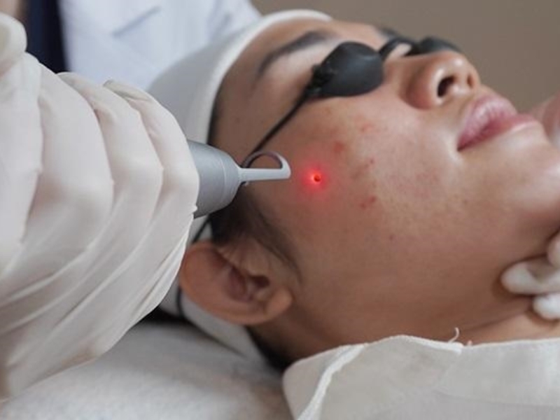 tẩy nốt ruồi bằng laser có đau không - 2