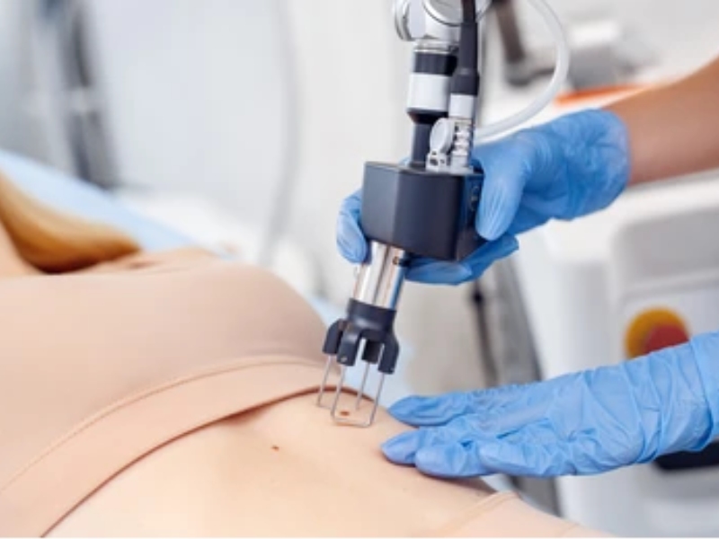 tẩy nốt ruồi bằng laser có đau không - 5