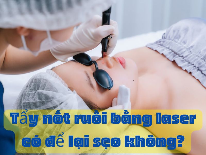 Tẩy nốt ruồi bằng laser có để lại sẹo không - 1