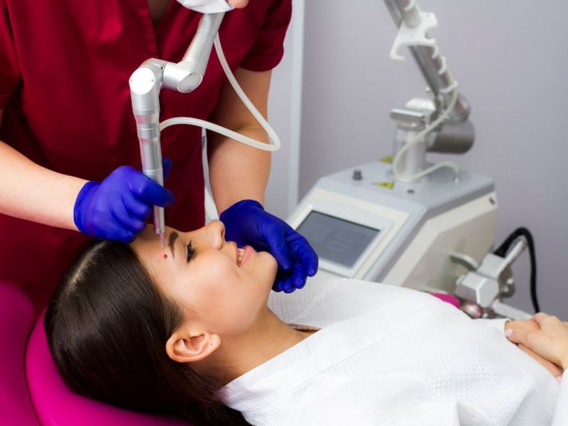 tẩy nốt ruồi bằng laser có để lại sẹo không - 3