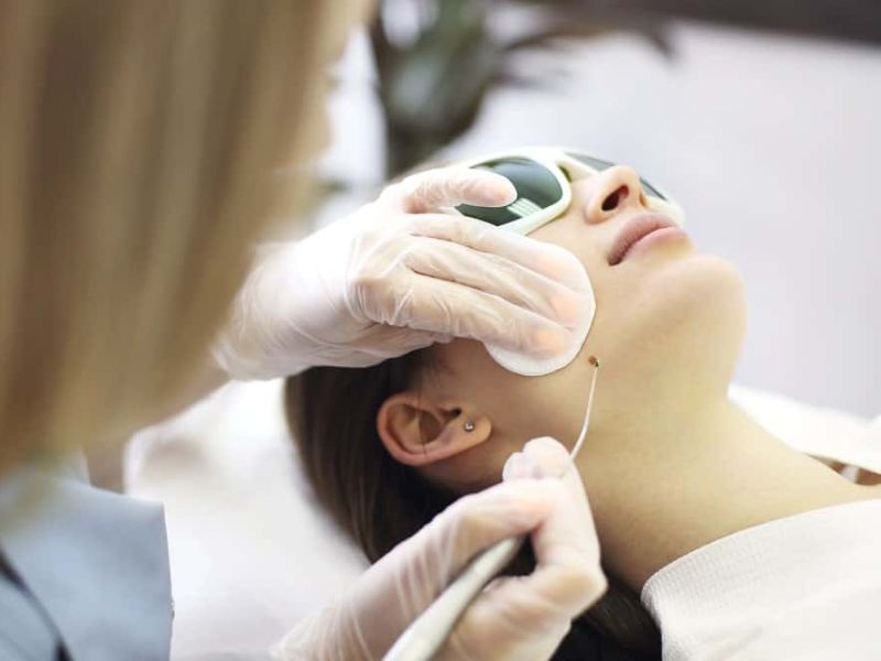 tẩy nốt ruồi bằng laser có để lại sẹo không - 4