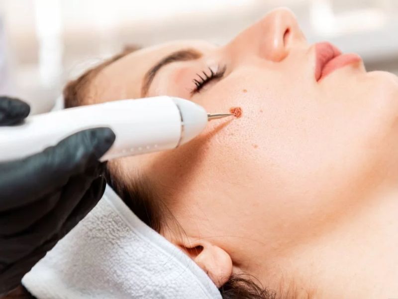 tẩy nốt ruồi bằng laser có để lại sẹo không - 5
