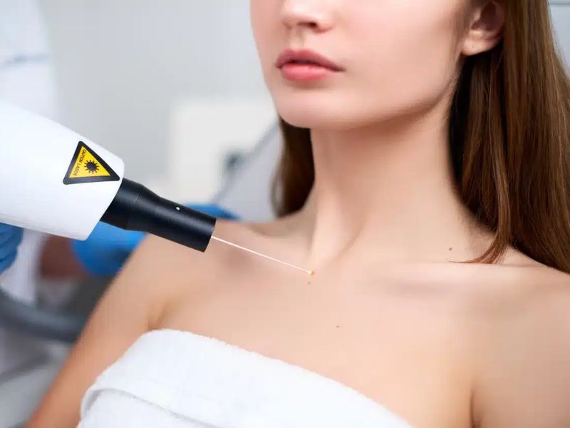 tẩy nốt ruồi bằng laser có để lại sẹo không - 6
