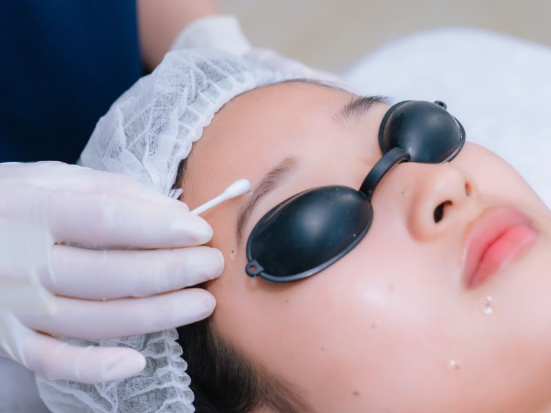 tẩy nốt ruồi bằng laser có để lại sẹo không - 8