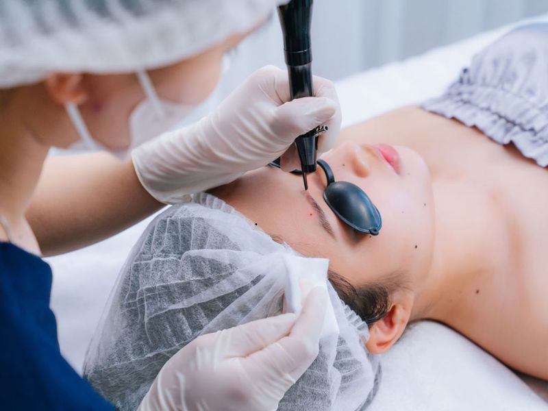 Tẩy nốt ruồi bằng laser có mọc lại không - 3