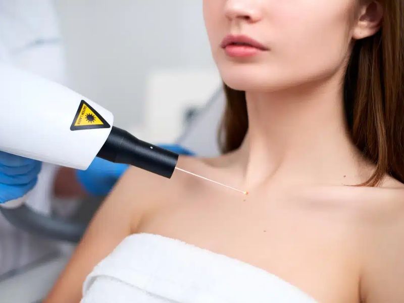 Tẩy nốt ruồi bằng laser kiêng nước bao lâu - 4