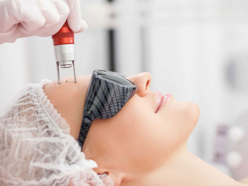 Tẩy nốt ruồi bằng tia laser bao nhiêu tiền - 5