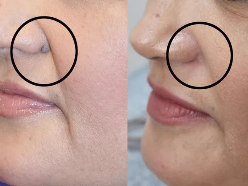 tẩy nốt ruồi bằng tia laser giá bao nhiêu - 2