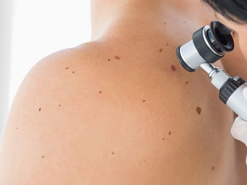 tẩy nốt ruồi bằng tia laser giá bao nhiêu - 4