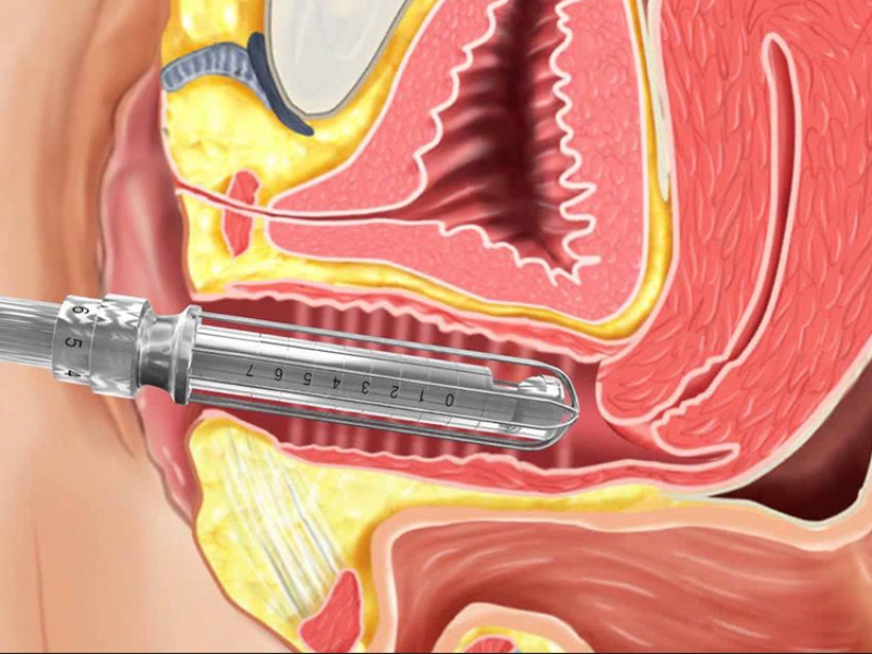 thu hẹp vùng kín bằng laser - 1
