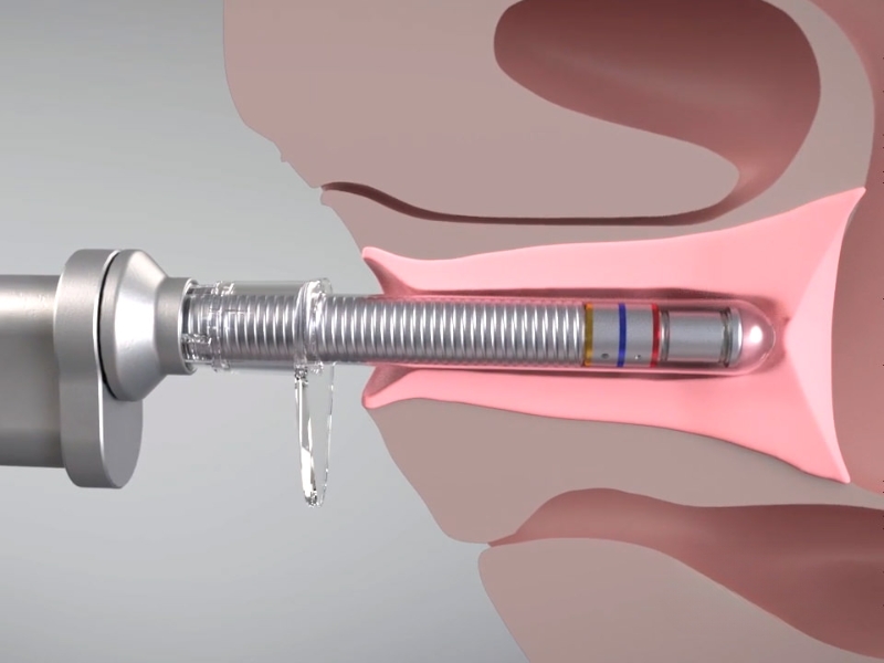 thu hẹp vùng kín bằng laser giá bao nhiêu - 2