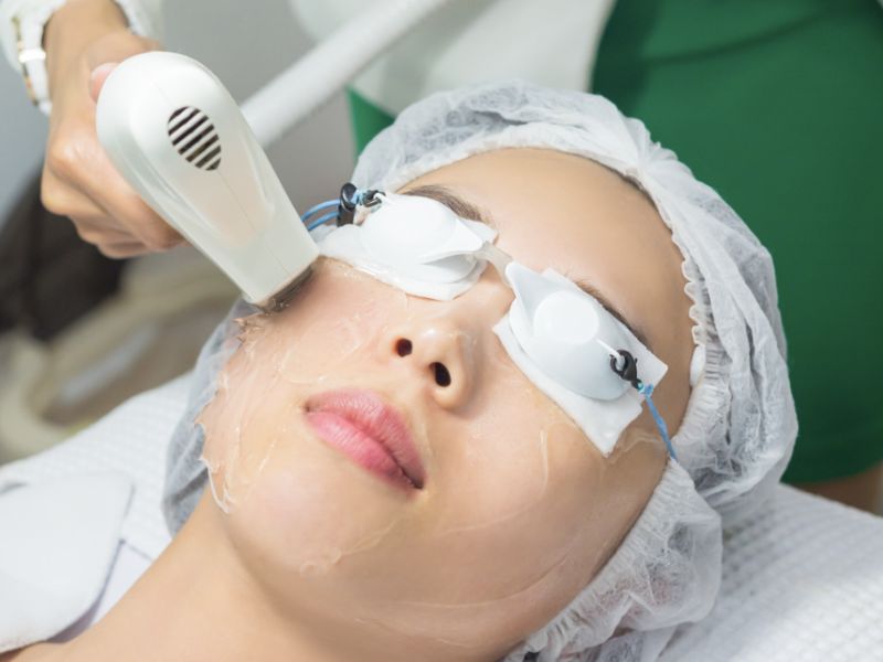 Trẻ hóa da bằng công nghệ IPL - 9